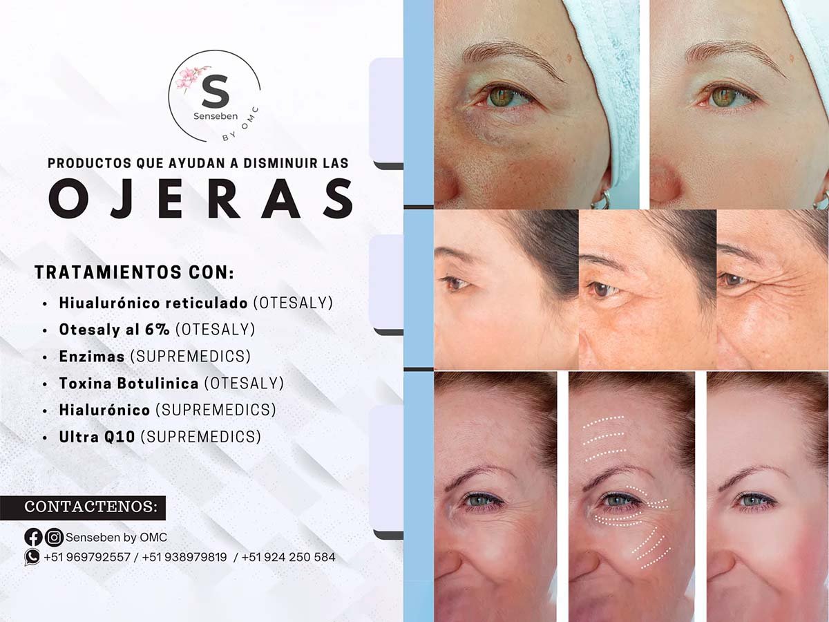 Tratamientos para ojeras con ácido hialurónico, enzimas y toxina botulínica Otesaly y Supremedics