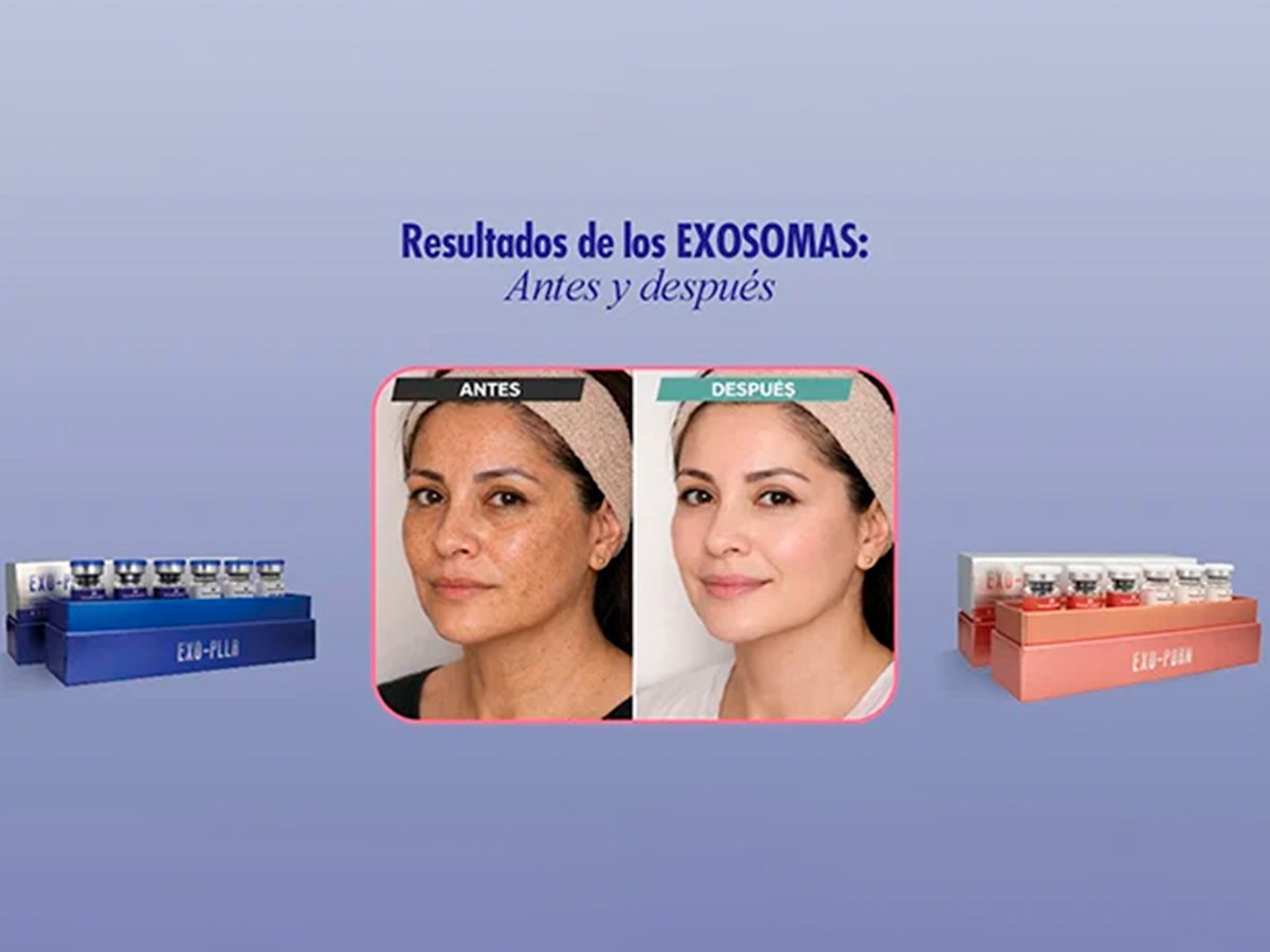 Resultados del tratamiento con exosomas faciales para rejuvenecimiento, mejora de firmeza y luminosidad de la piel