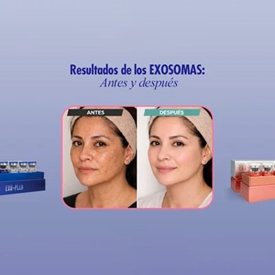 Resultados del tratamiento con exosomas faciales para rejuvenecimiento, mejora de firmeza y luminosidad de la piel
