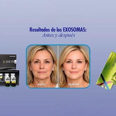Exosomas PDRN aplicados en tratamiento facial regenerativo para rejuvenecimiento de la piel