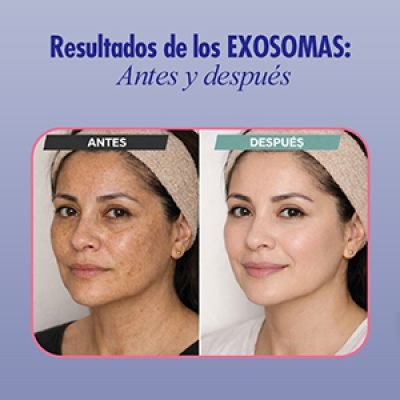 Resultados del tratamiento con exosomas faciales para rejuvenecimiento, mejora de firmeza y luminosidad de la piel